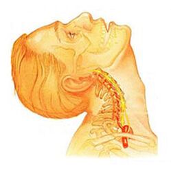 Ang osteochondrosis sa cervical spine