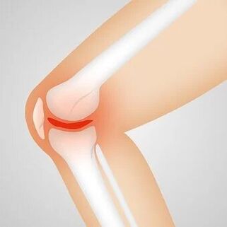 Ang arthrosis usa ka non-inflammatory joint pathology