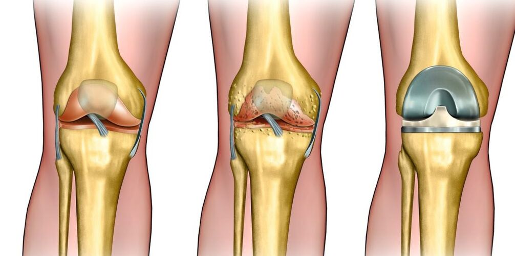 Arthrosis sa lutahan sa tuhod