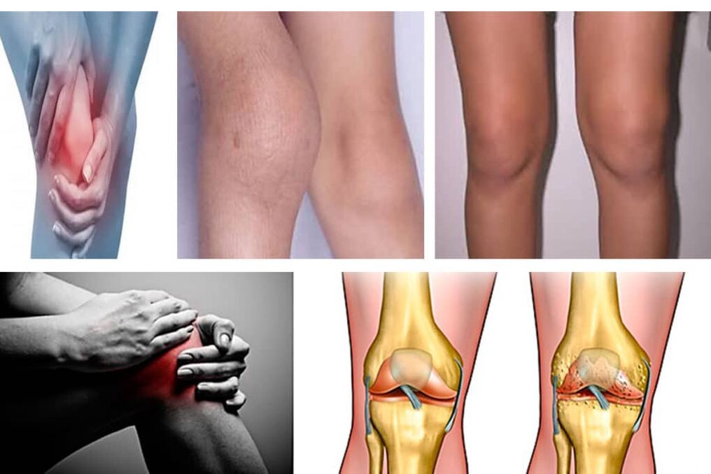 Mga Sintomas sa Arthrosis sa tuhod